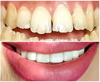 Veneers